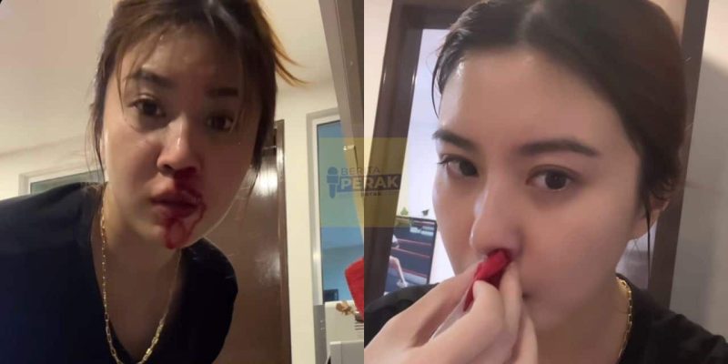 Alami pendarahan hidung 4 jam tanpa henti, Elizabeth Tan dedah ini yang terjadi pada dirinya