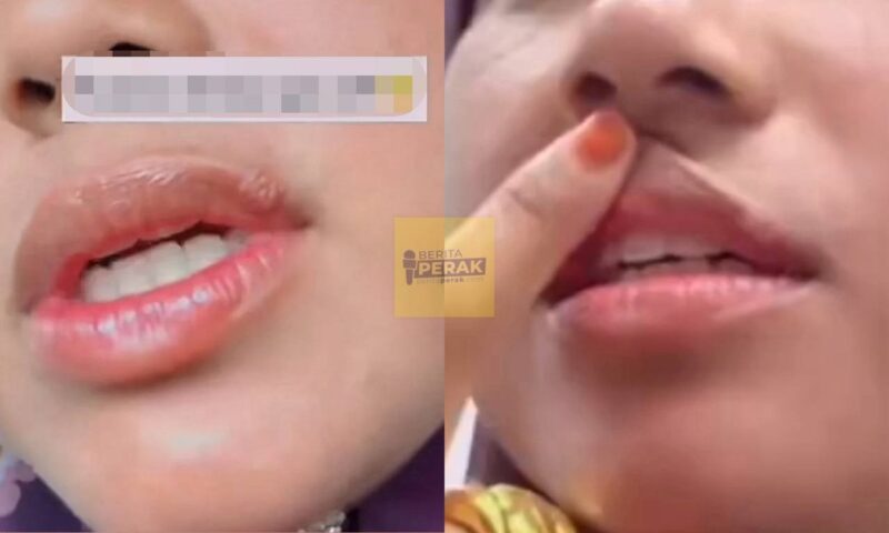 “Sangka cuma ulser biasa, rupanya..” – Ini gejala dan punca oral Herpes “Sangka cuma ulser biasa, rupanya..” – Ini gejala dan punca oral Herpes